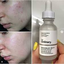 The Ordinary Niacinamide 10% + Zinc 1 % - 30ml